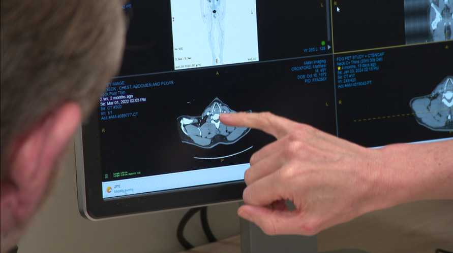 New Immunotherapy Cuts Advanced Melanoma Recurrence to Under 5%